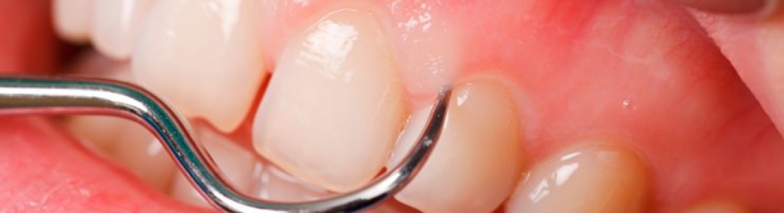 Diş Eti Büyümeleri Özel Dentilife Ağız Ve Diş Sağlığı Polikiliniği